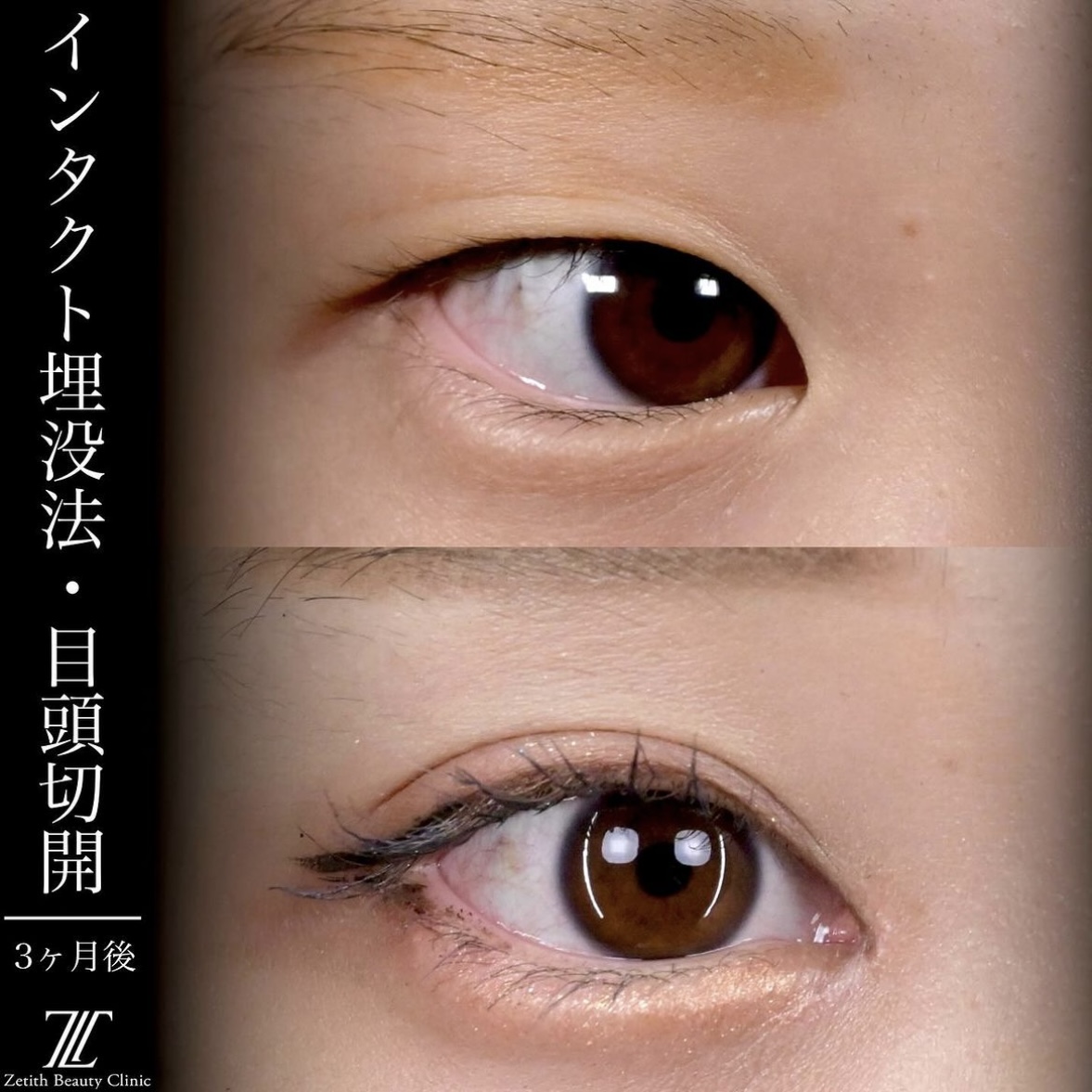 上木原医師による目元整形の術前/術後3ヶ月後 施術後 
