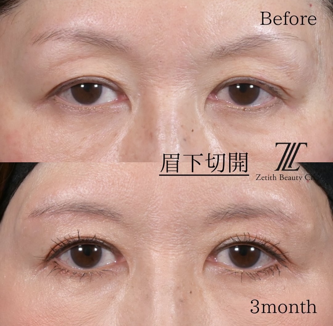 林医師による眉下切開の施術前/術後3ヶ月