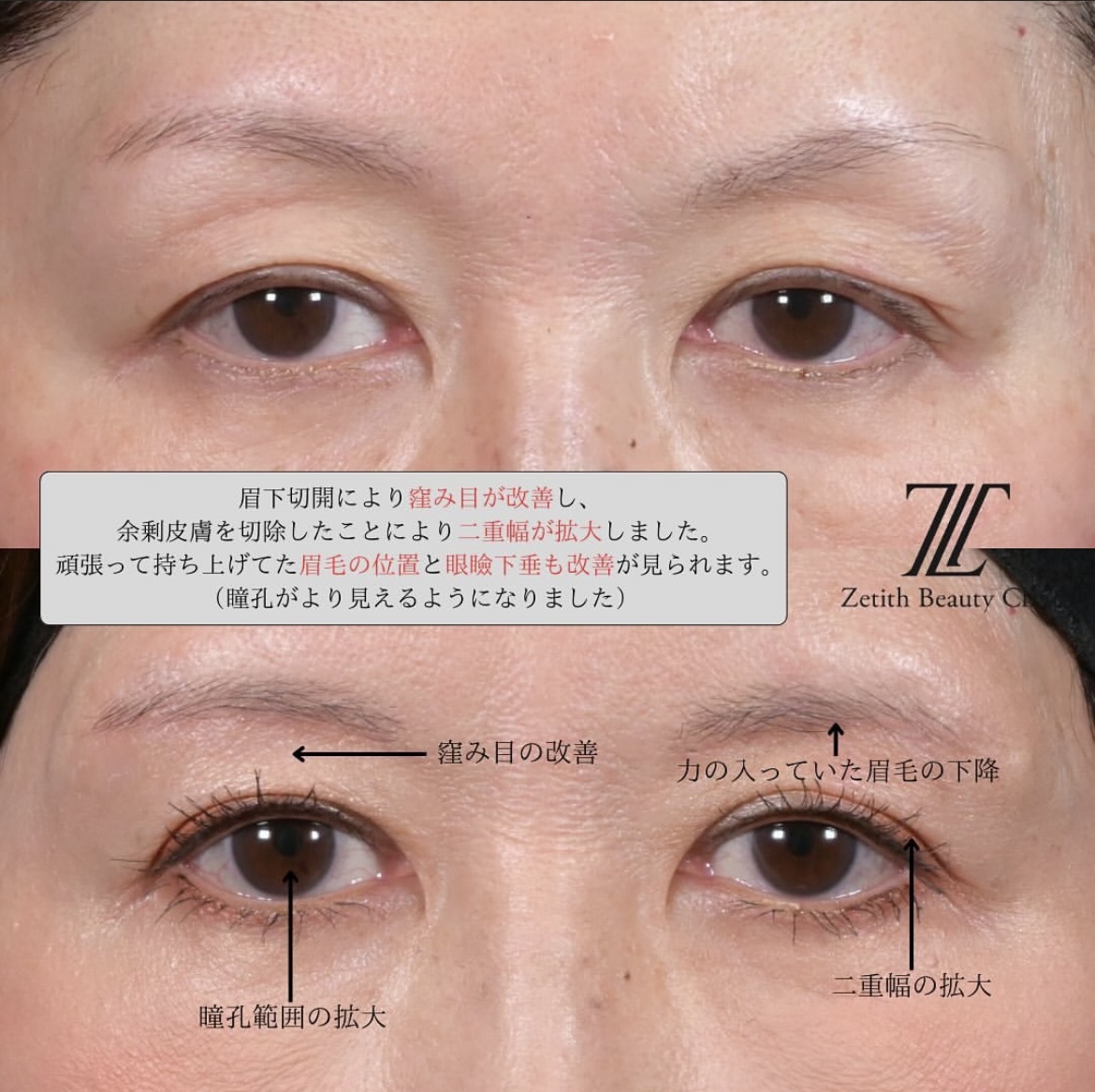 林医師による眉下切開の施術前/術後3ヶ月 施術後 