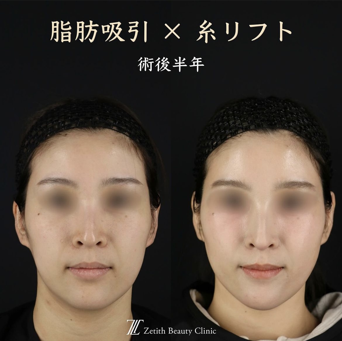 王医師による脂肪吸引×糸リフト施術前/術後半年