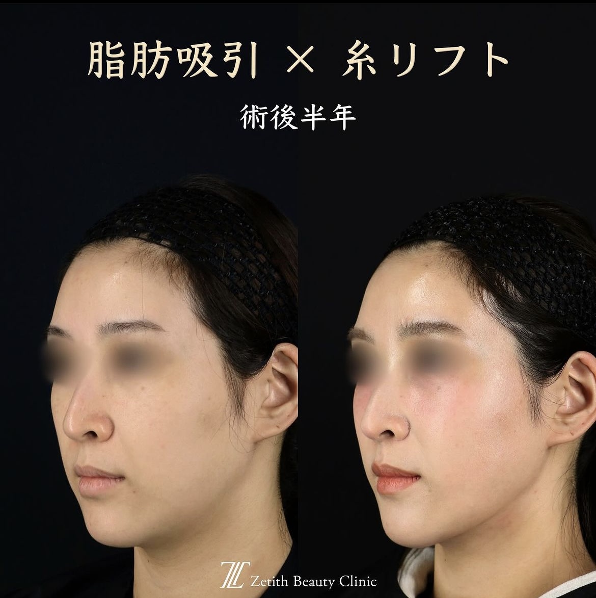 王医師による脂肪吸引×糸リフト施術前/術後半年 بعد 