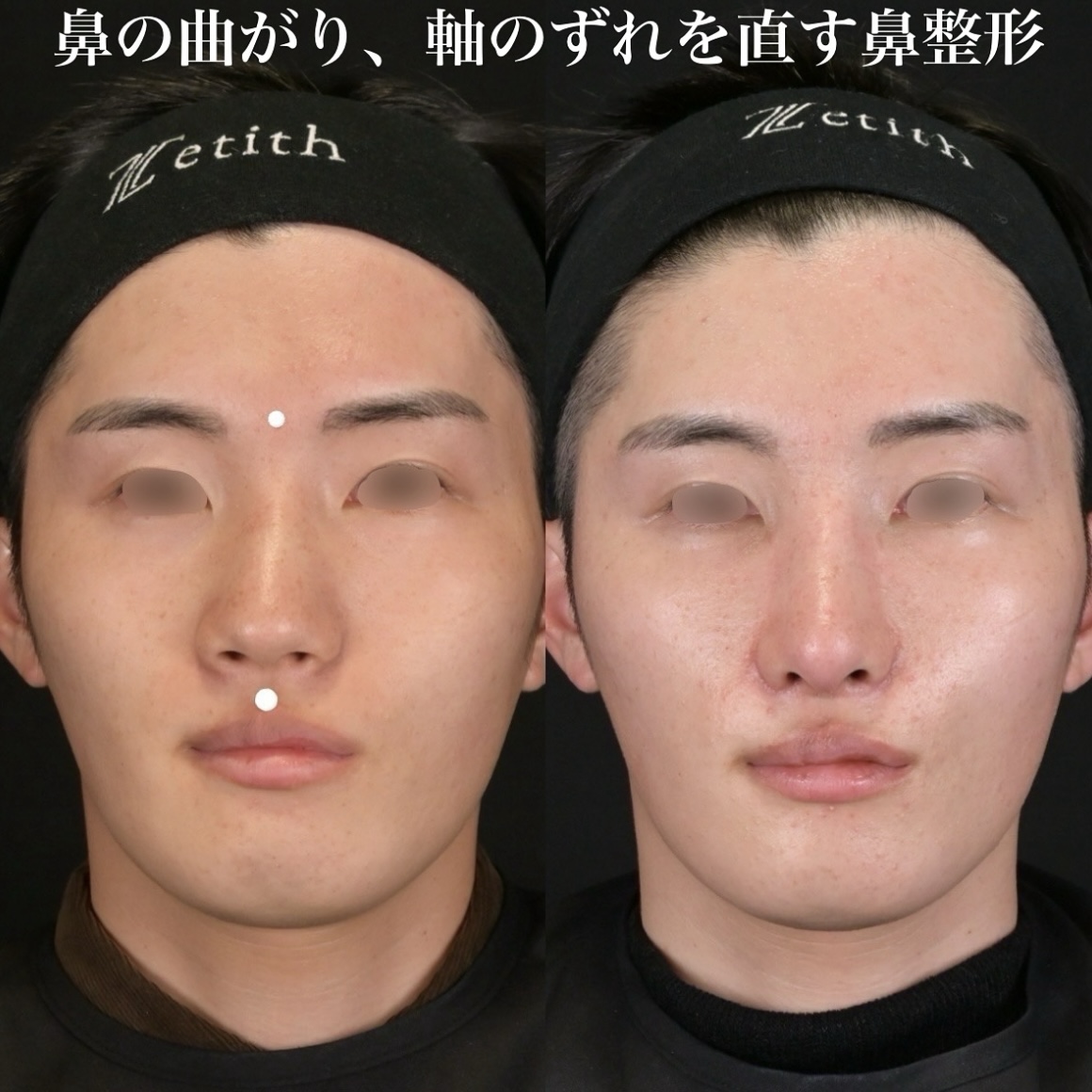 鉄医師による術後鼻整形の術前/ 術後3ヶ月