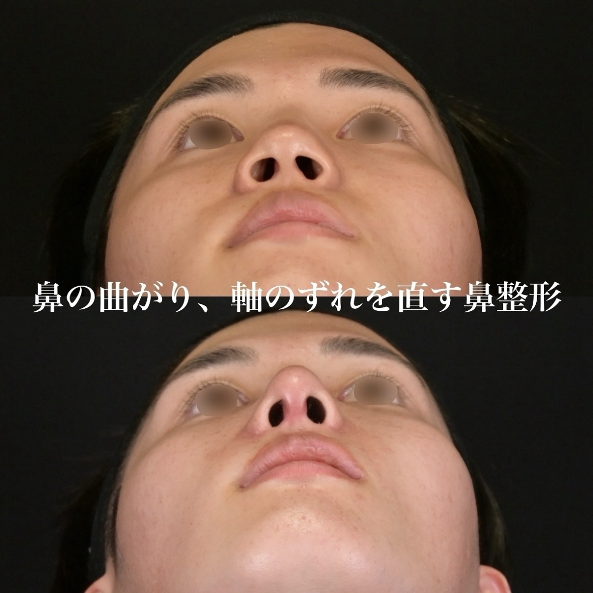 鉄医師による術後鼻整形の術前/ 術後3ヶ月 术后 