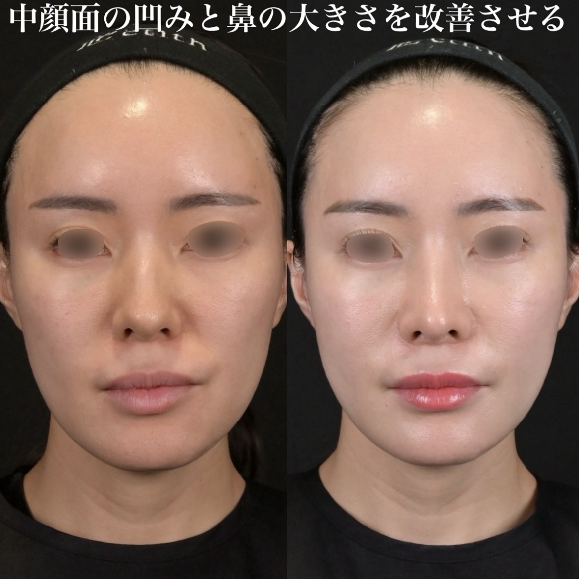 鉄医師による鼻整形の術前/術後3ヶ月