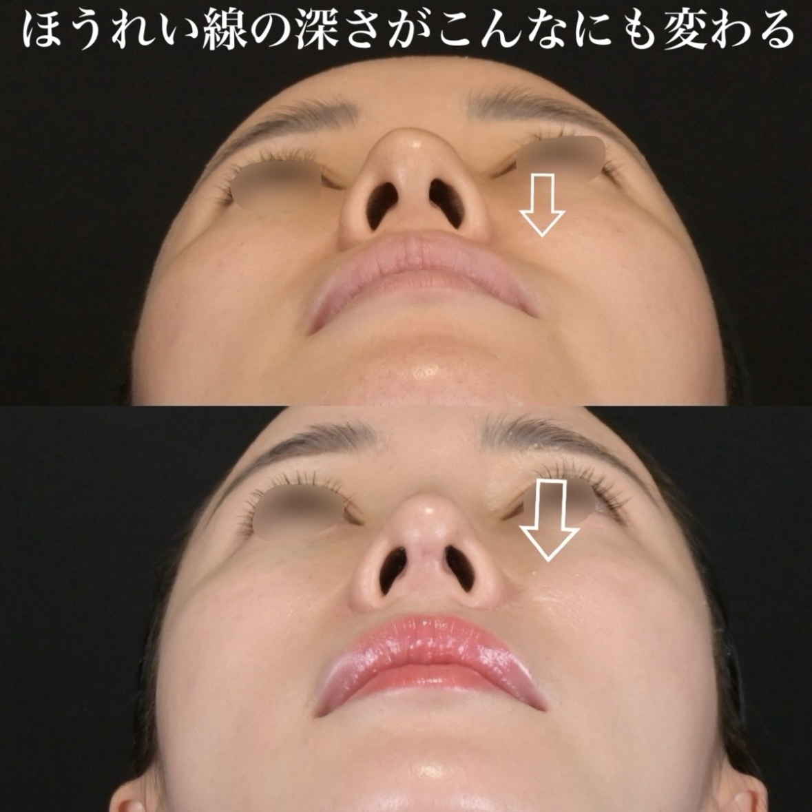 鉄医師による鼻整形の術前/術後3ヶ月 หลัง 