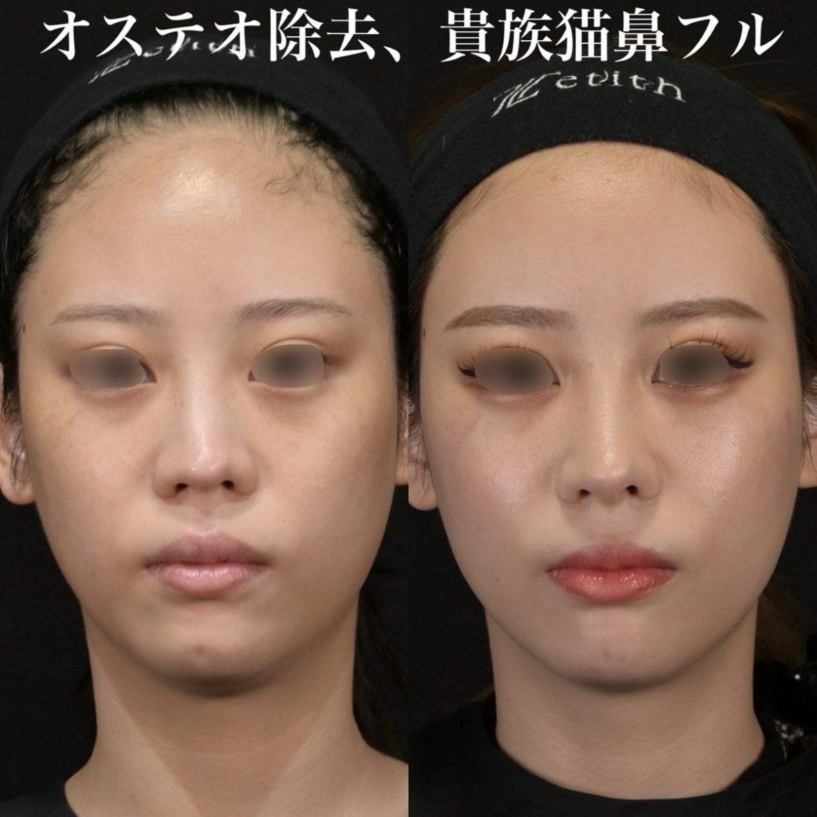 鉄医師による鼻整形術前/術後6ヶ月