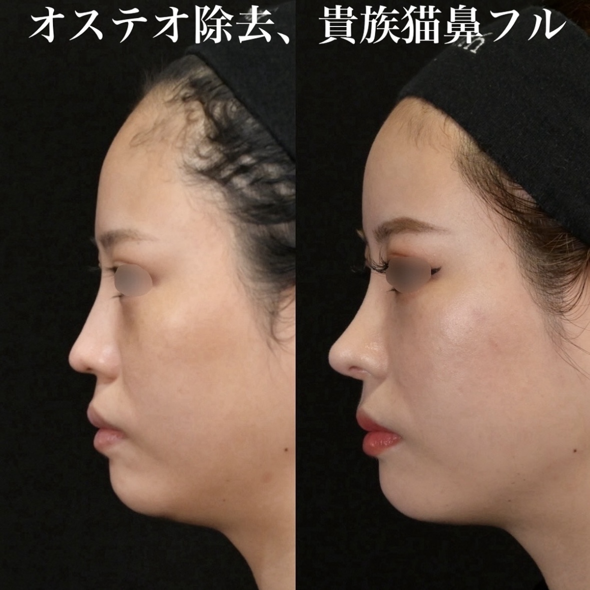 鉄医師による鼻整形術前/術後6ヶ月 施術後 