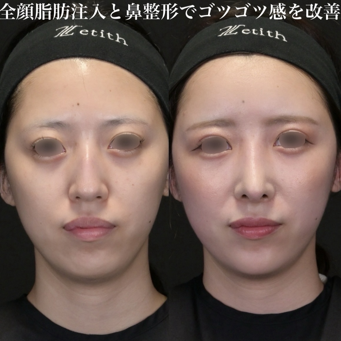 鉄医師による鼻整形術前/術後3ヶ月