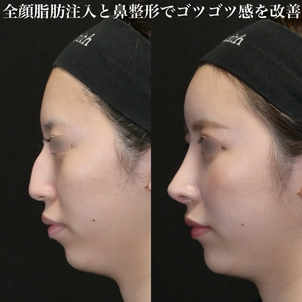 鉄医師による鼻整形術前/術後3ヶ月 หลัง 