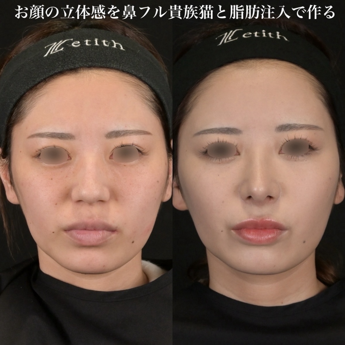 鉄医師による鼻整形の術前/術後1ヶ月
