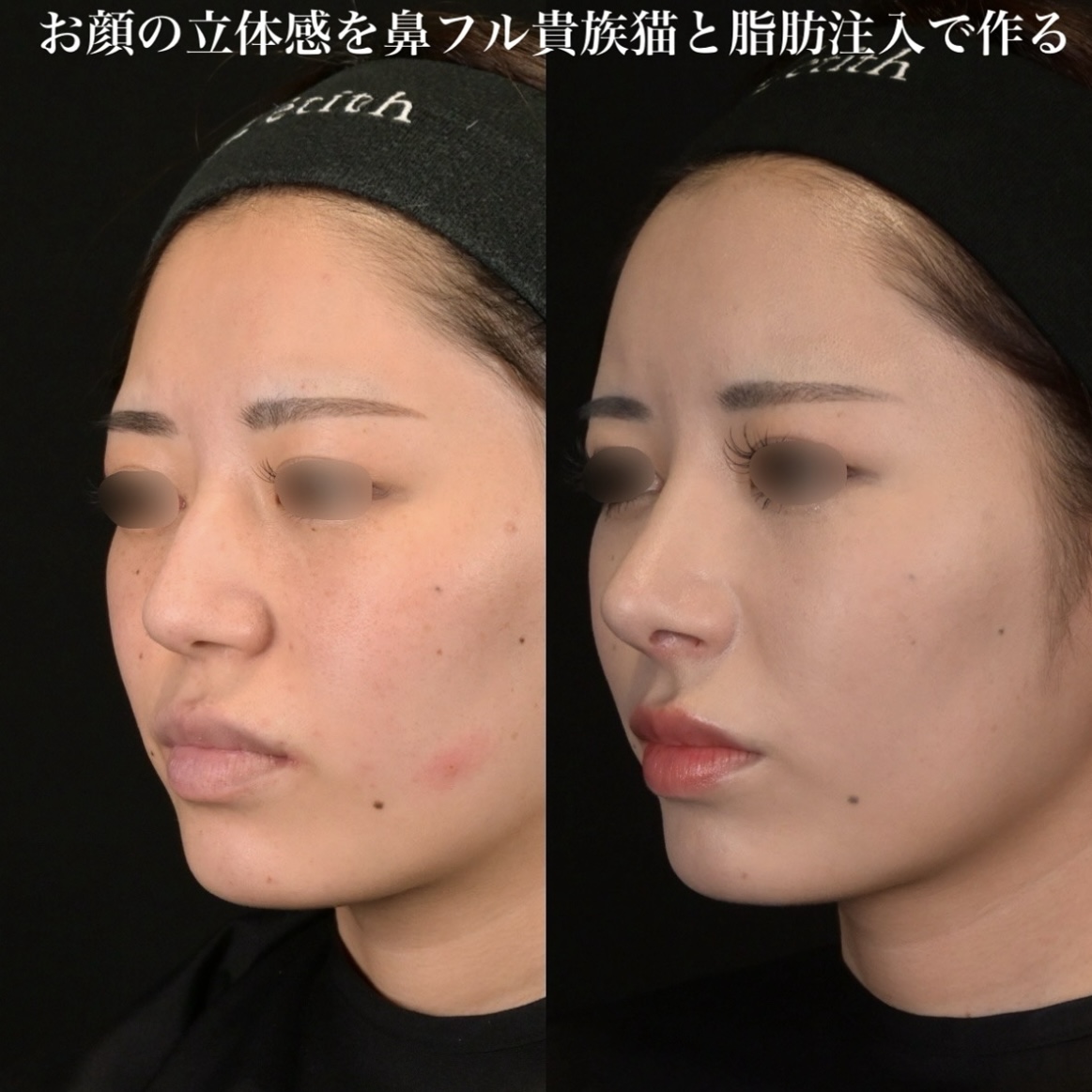 鉄医師による鼻整形の術前/術後1ヶ月 施術後 