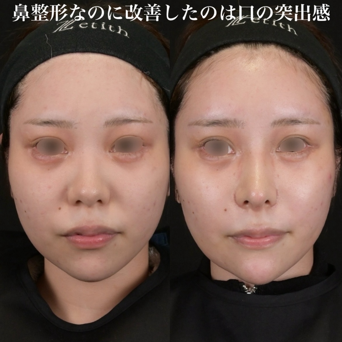 鉄医師による鼻整形の術前/術後2週間