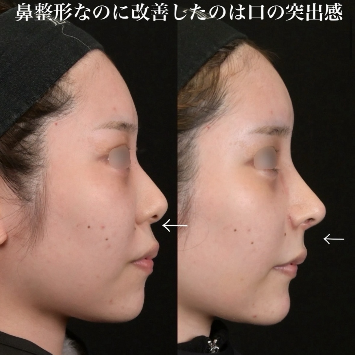 鉄医師による鼻整形の術前/術後2週間 施術後 