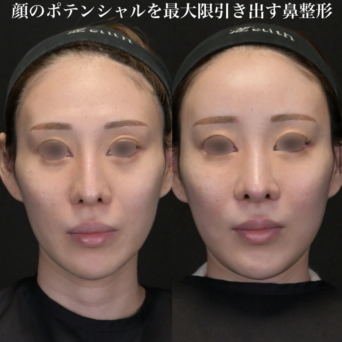 鉄医師による鼻整形の術前/術後3ヶ月