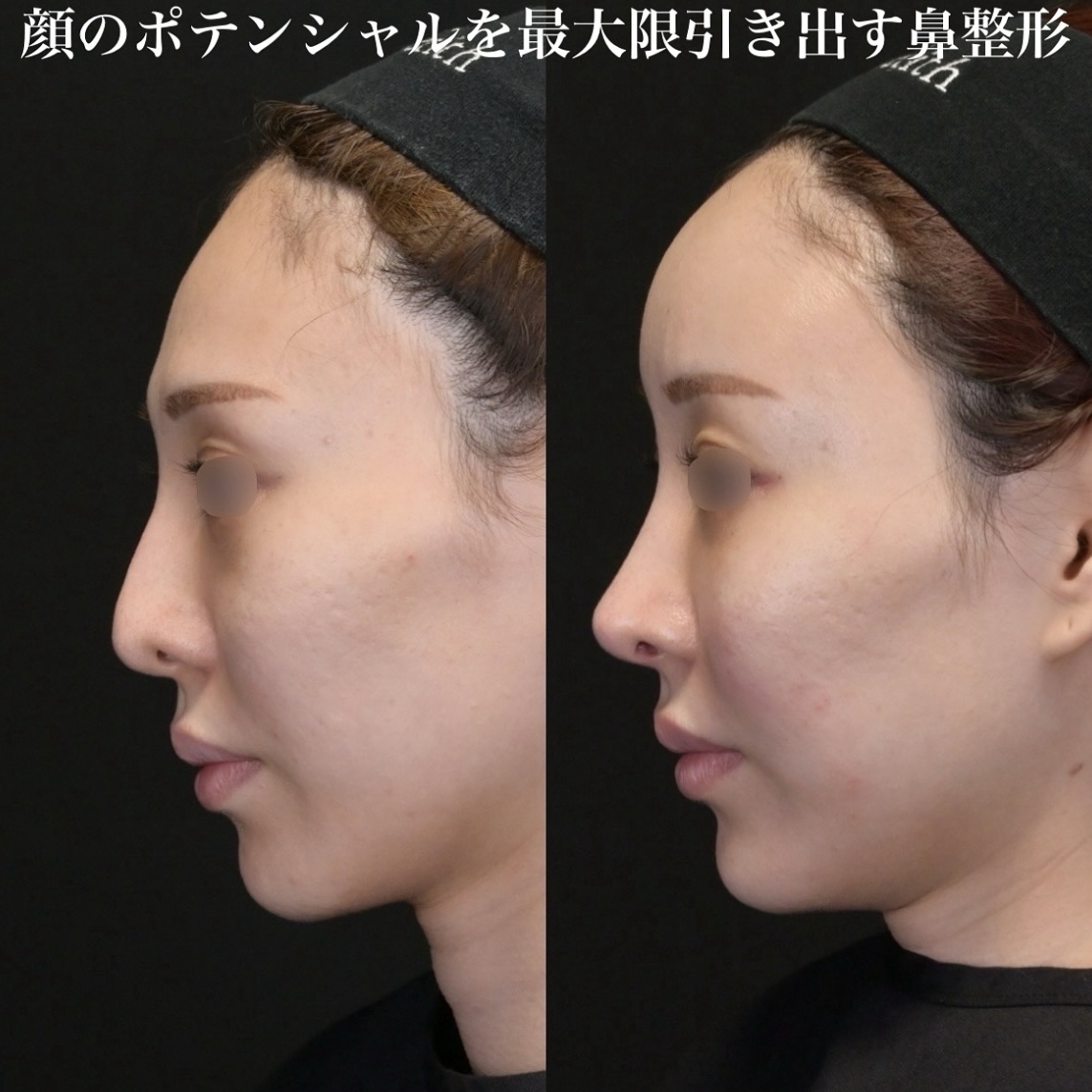 鉄医師による鼻整形の術前/術後3ヶ月 施術後 