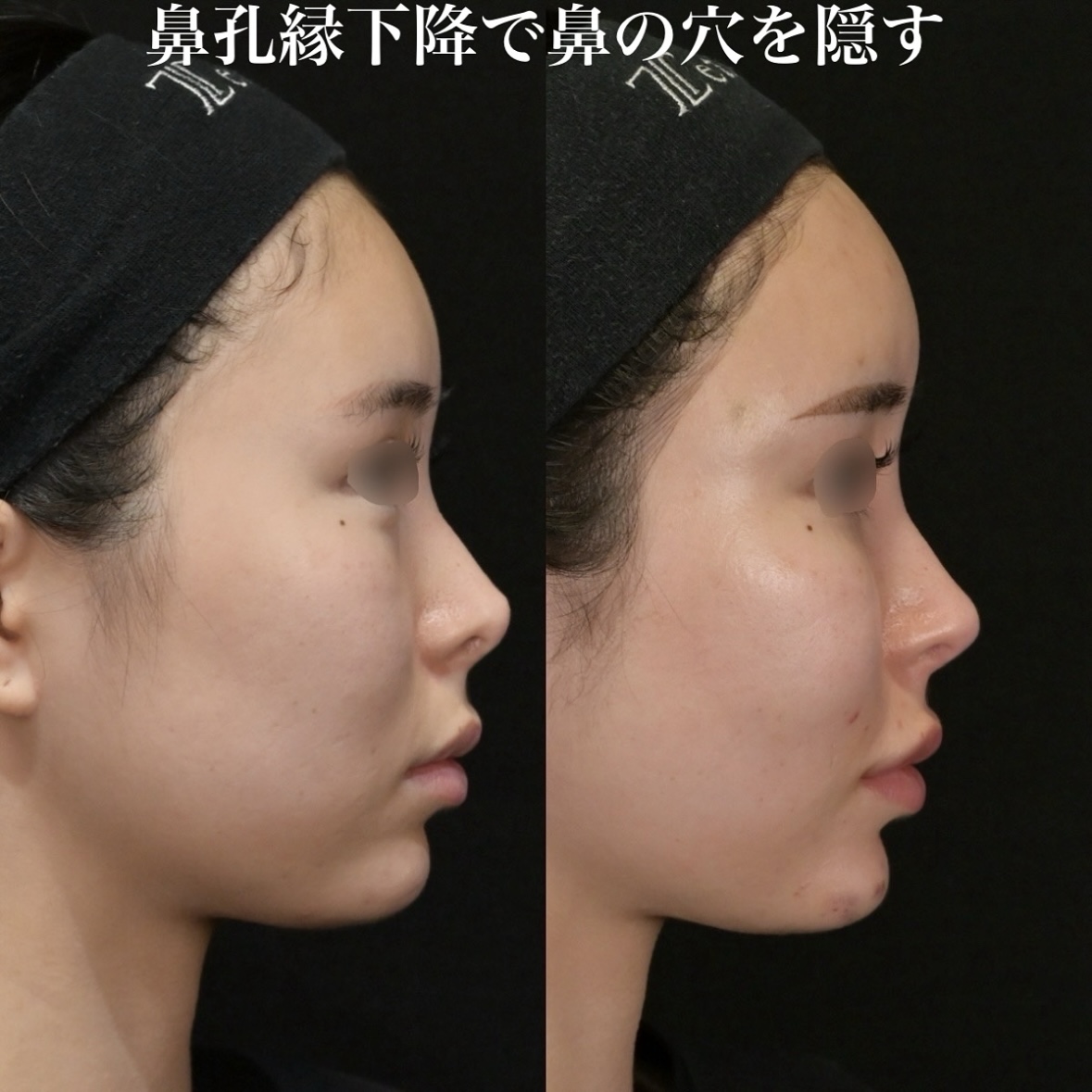鉄医師による鼻手術の術前/術後6ヶ月