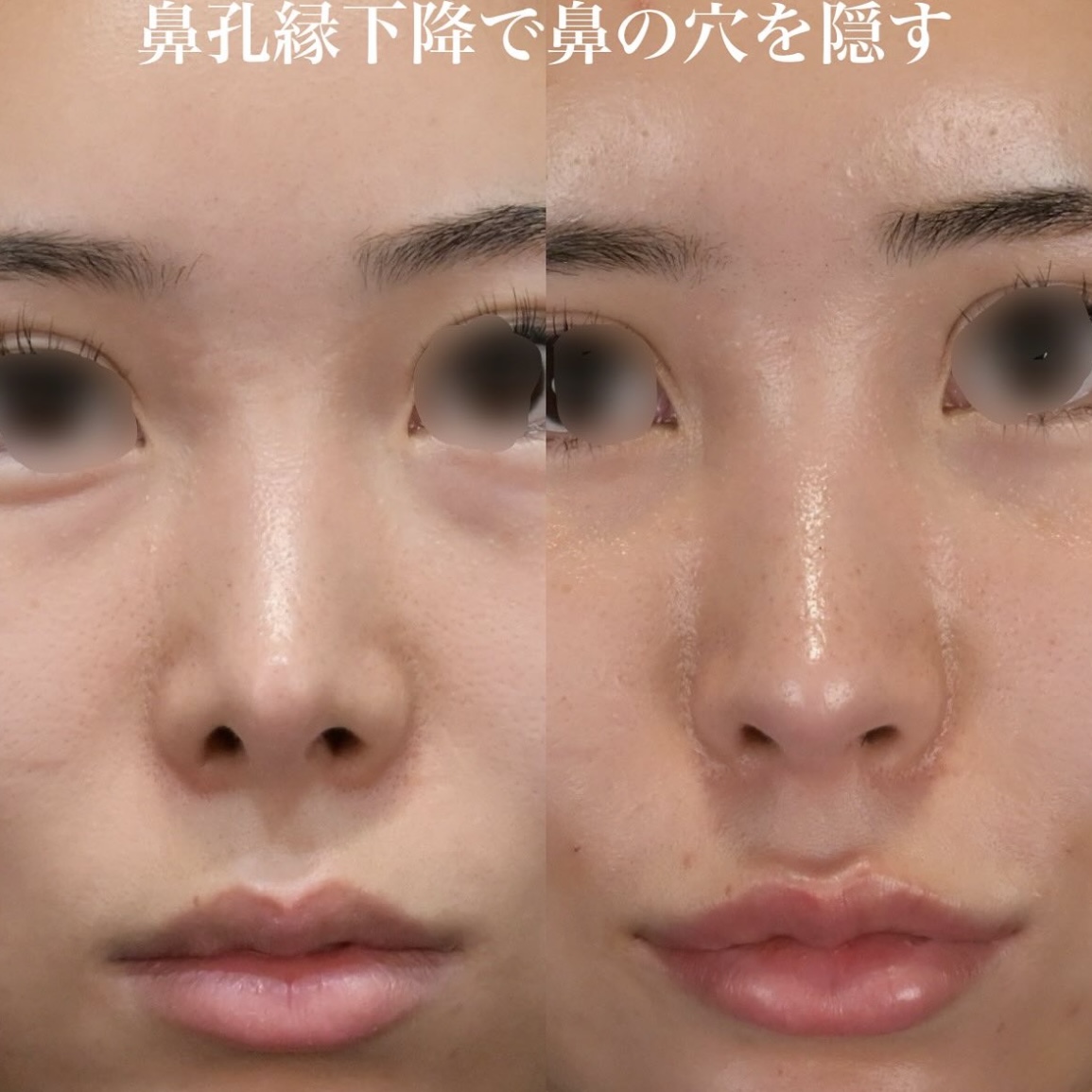 鉄医師による鼻手術の術前/術後6ヶ月 术后 