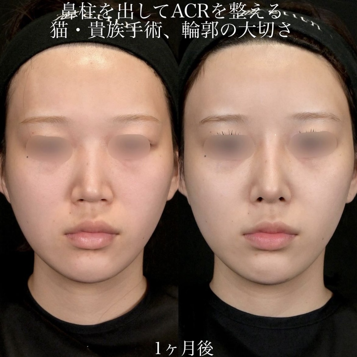 上木原医師による鼻整形の術前/術後1ヶ月