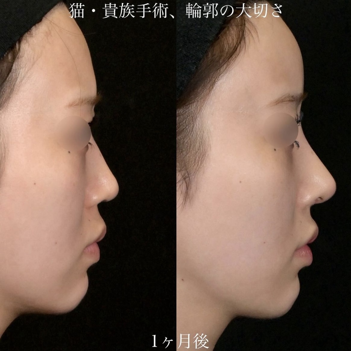 上木原医師による鼻整形の術前/術後1ヶ月 Дараа 