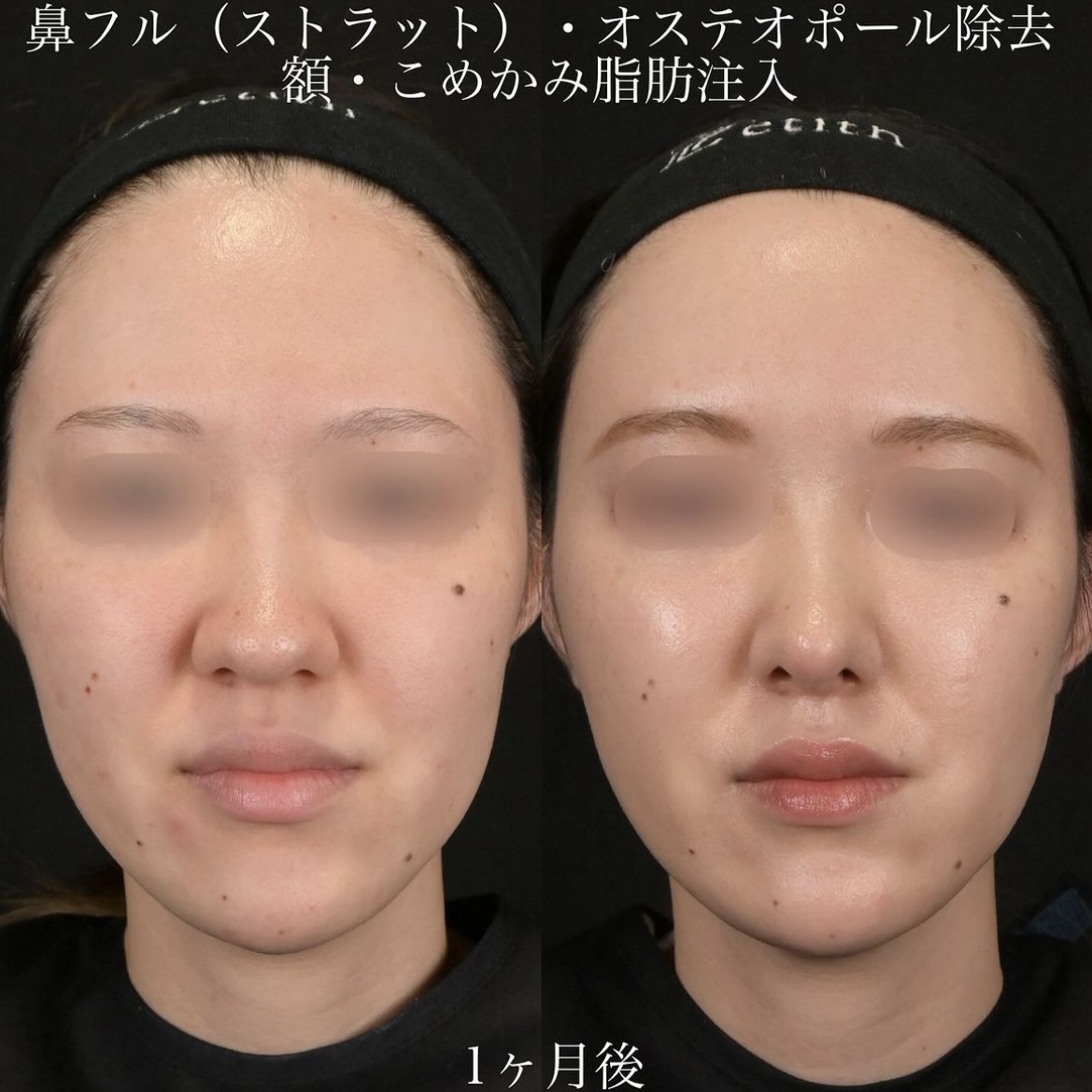 上木原医師による鼻整形の術前/術後1ヶ月