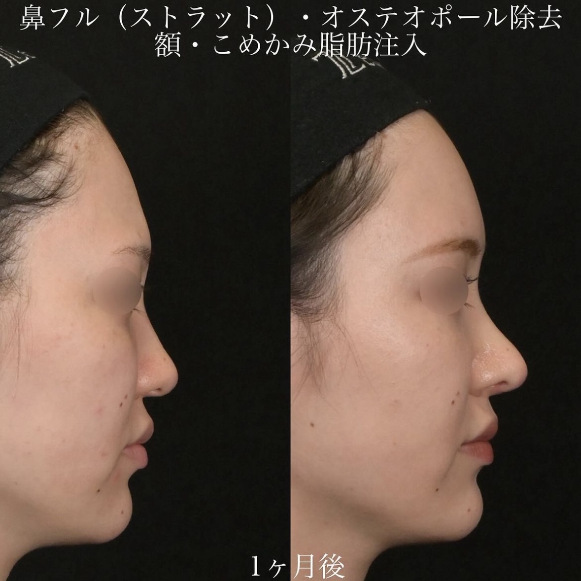 上木原医師による鼻整形の術前/術後1ヶ月 术后 