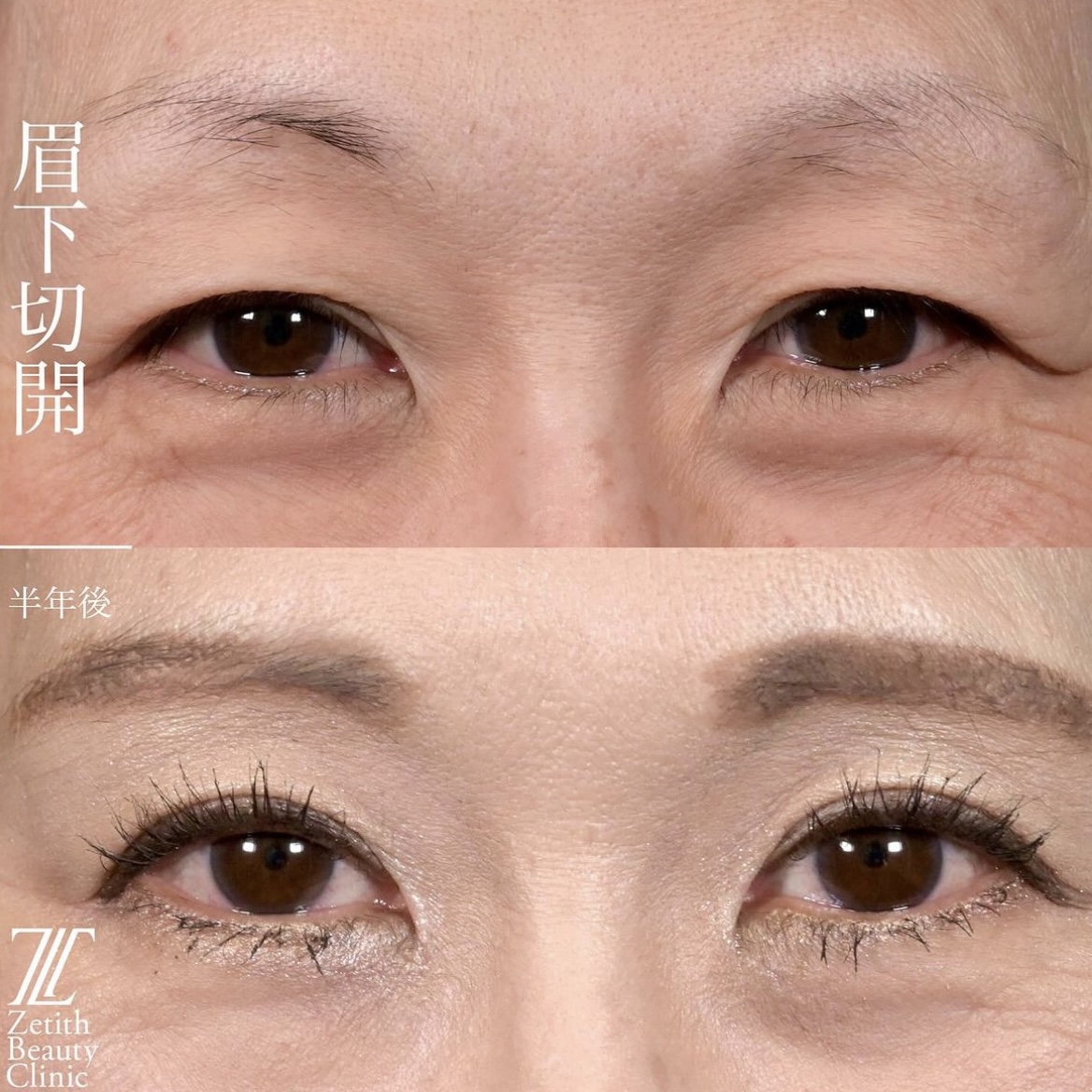 上木原医師による目元整形の施術前/施術後6ヶ月