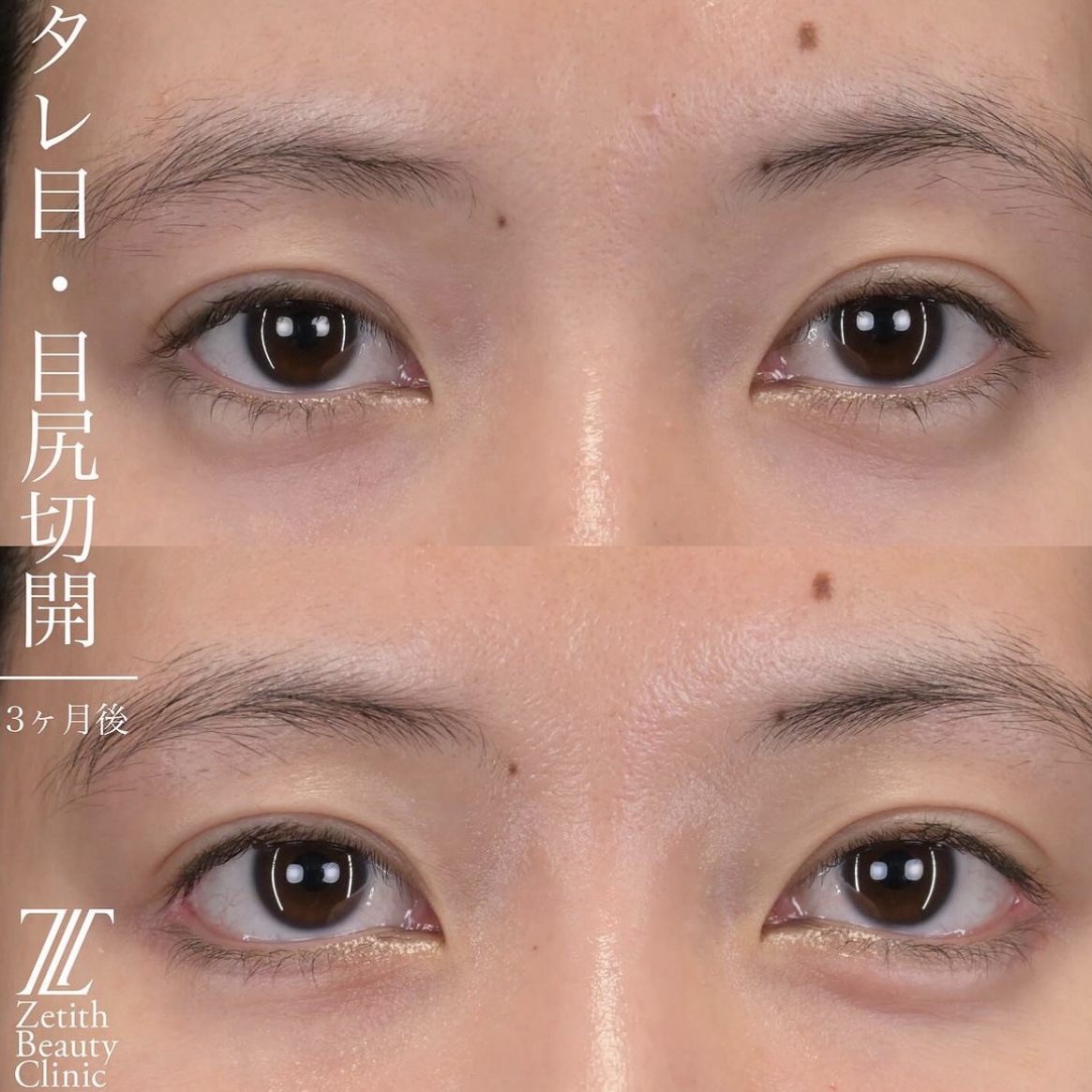 上木原医師による目元整形の施術前/施術後3ヶ月