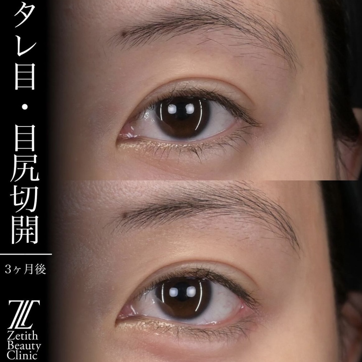 上木原医師による目元整形の施術前/施術後3ヶ月 Sau 