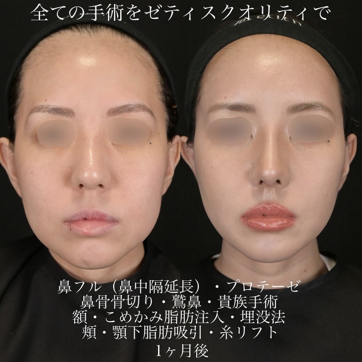 上木原医師による鼻整形の施術前/施術後1ヶ月