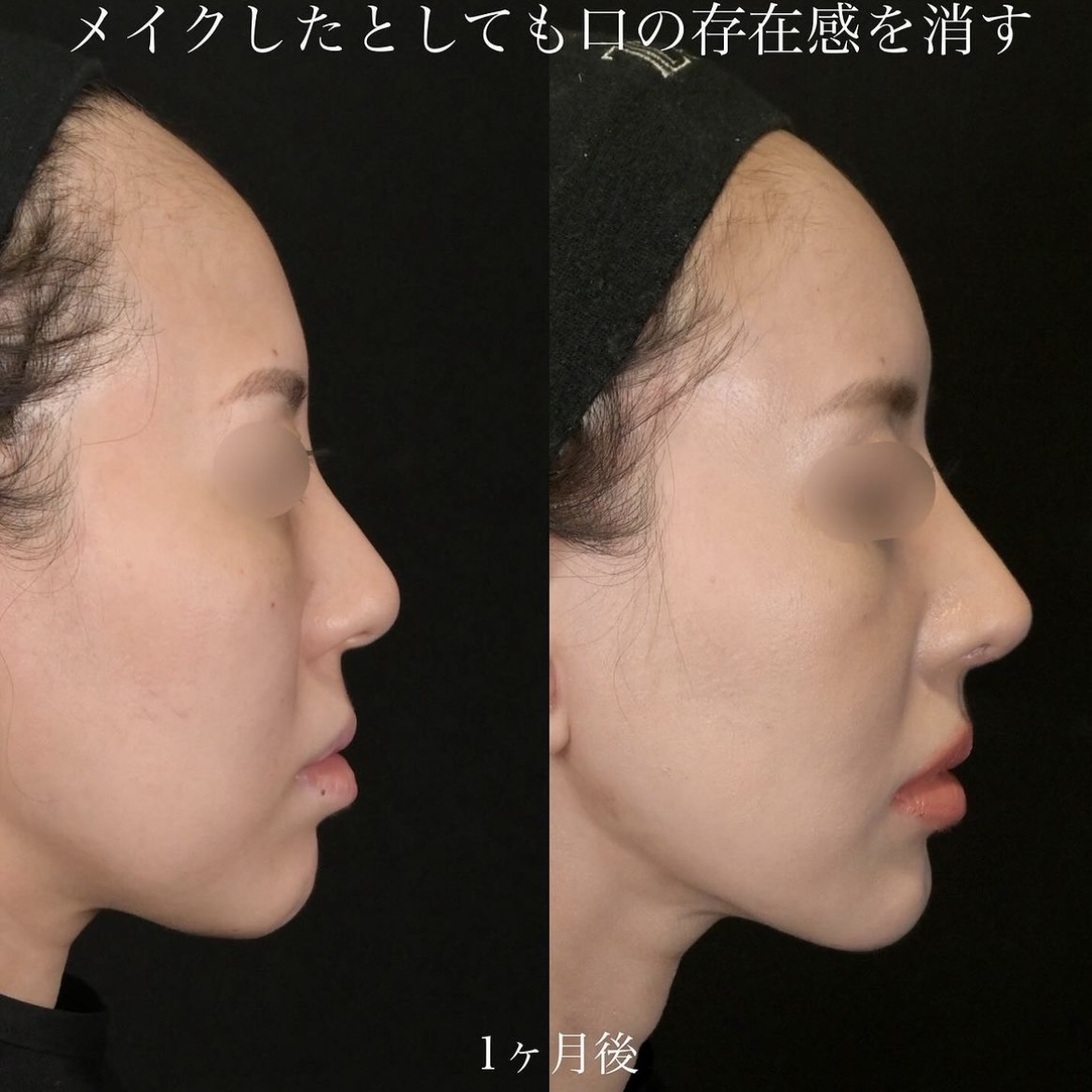 上木原医師による鼻整形の施術前/施術後1ヶ月 术后 