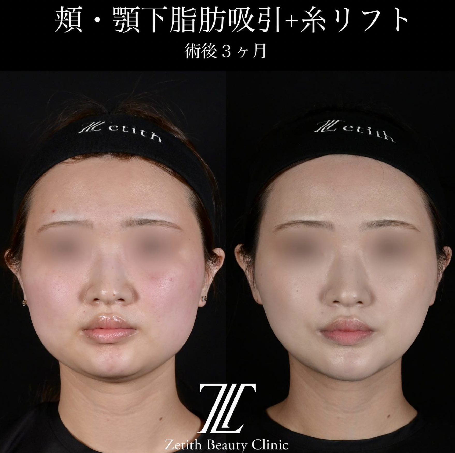 北村医師による脂肪吸引リフトの施術前／施術後3ヶ月 施術後 