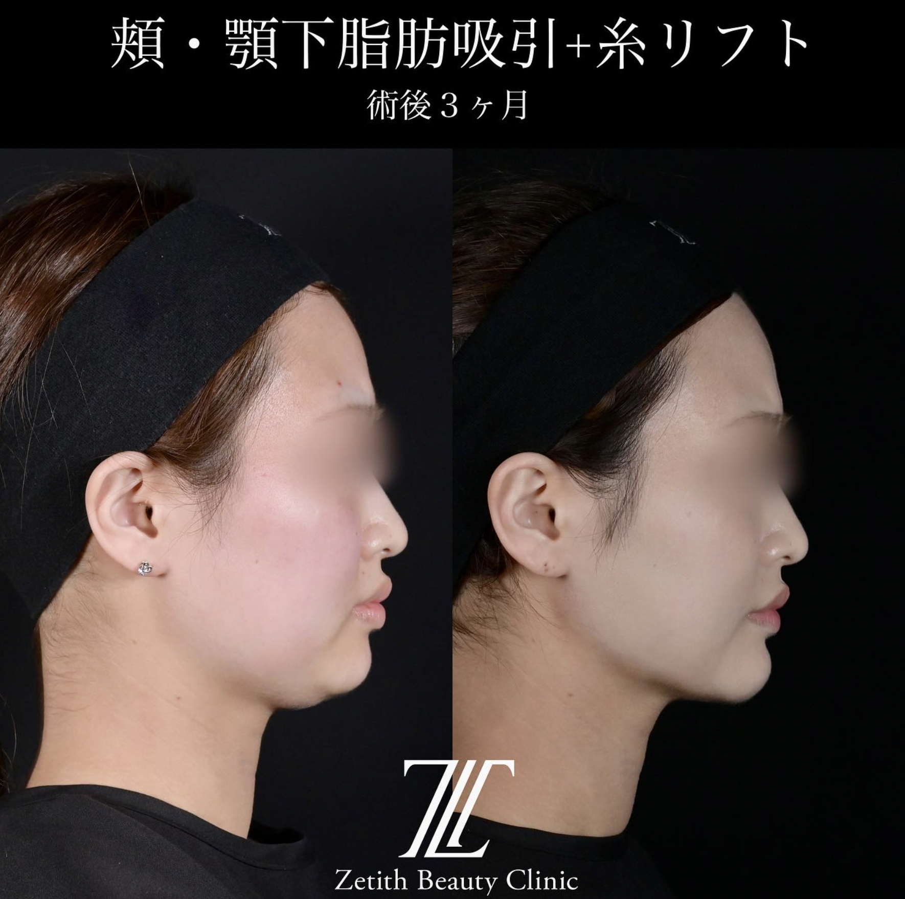 北村医師による脂肪吸引リフトの施術前／施術後3ヶ月