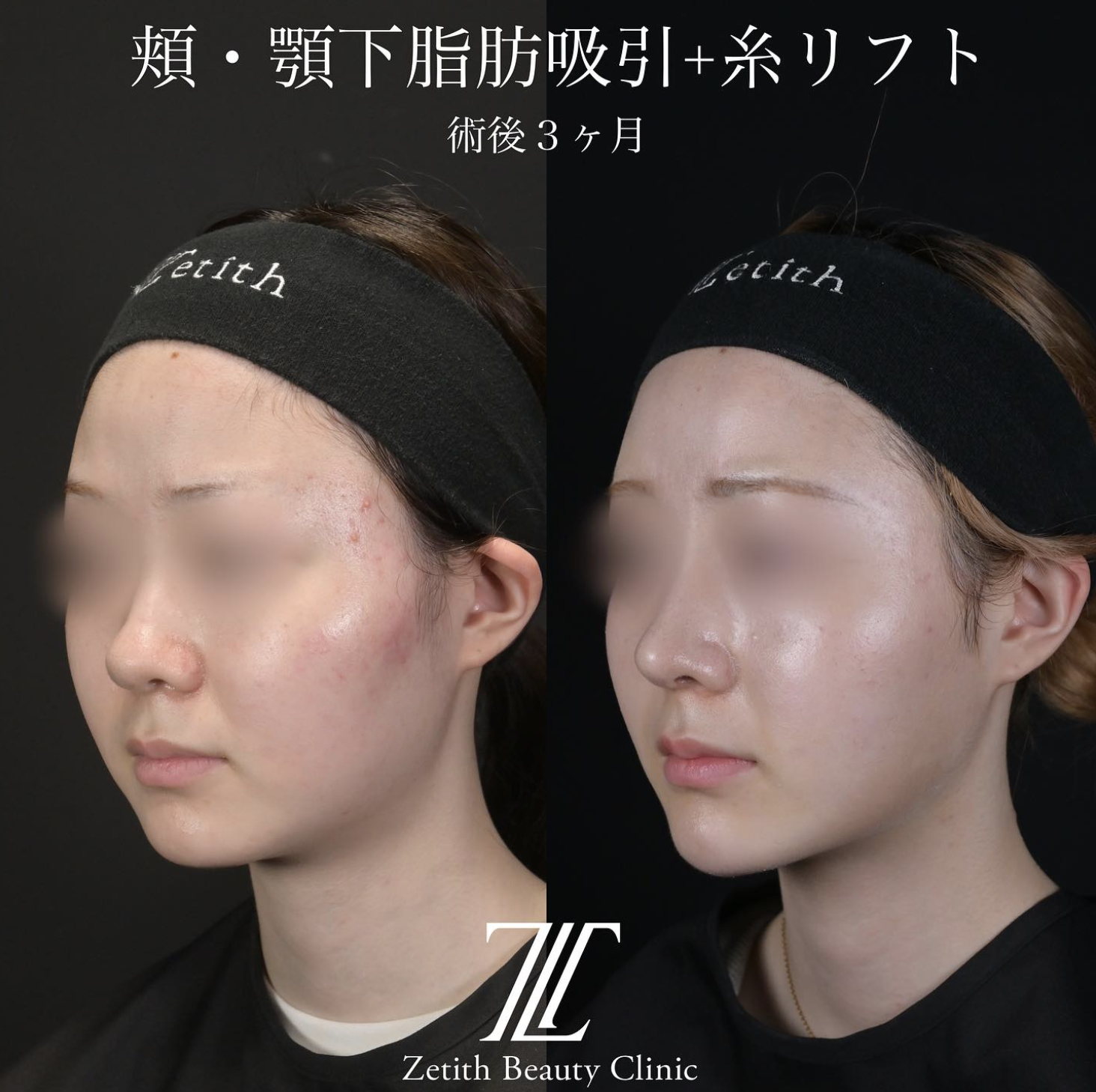 北村医師による脂肪吸引リフトの施術前／施術後3ヶ月