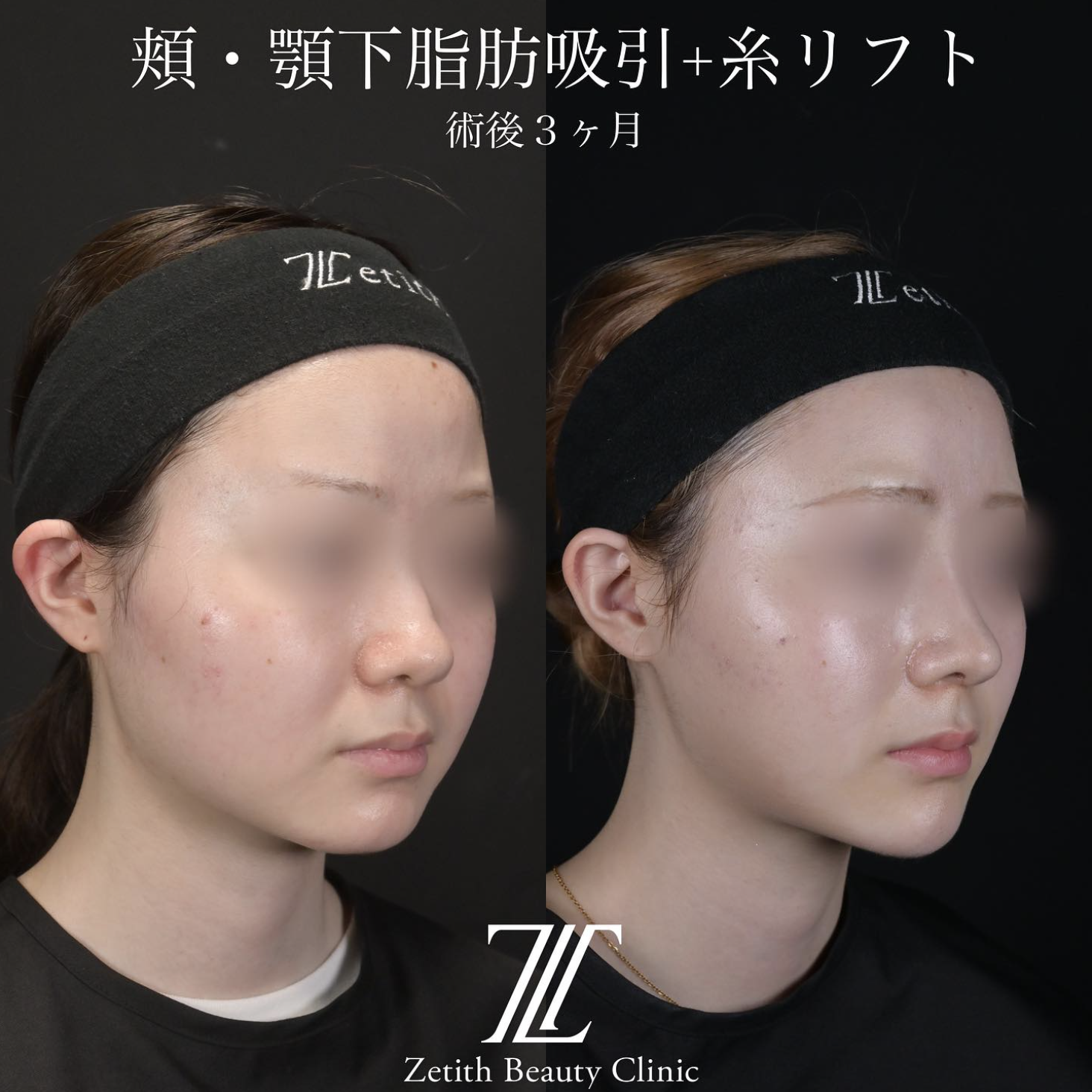 北村医師による脂肪吸引リフトの施術前／施術後3ヶ月 Sau 