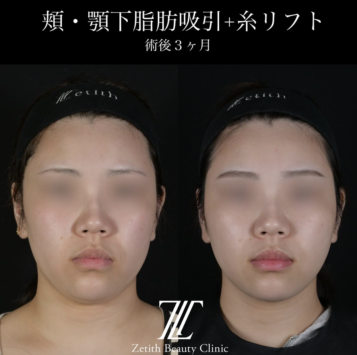北村医師による脂肪吸引リフトの施術前／施術後3ヶ月