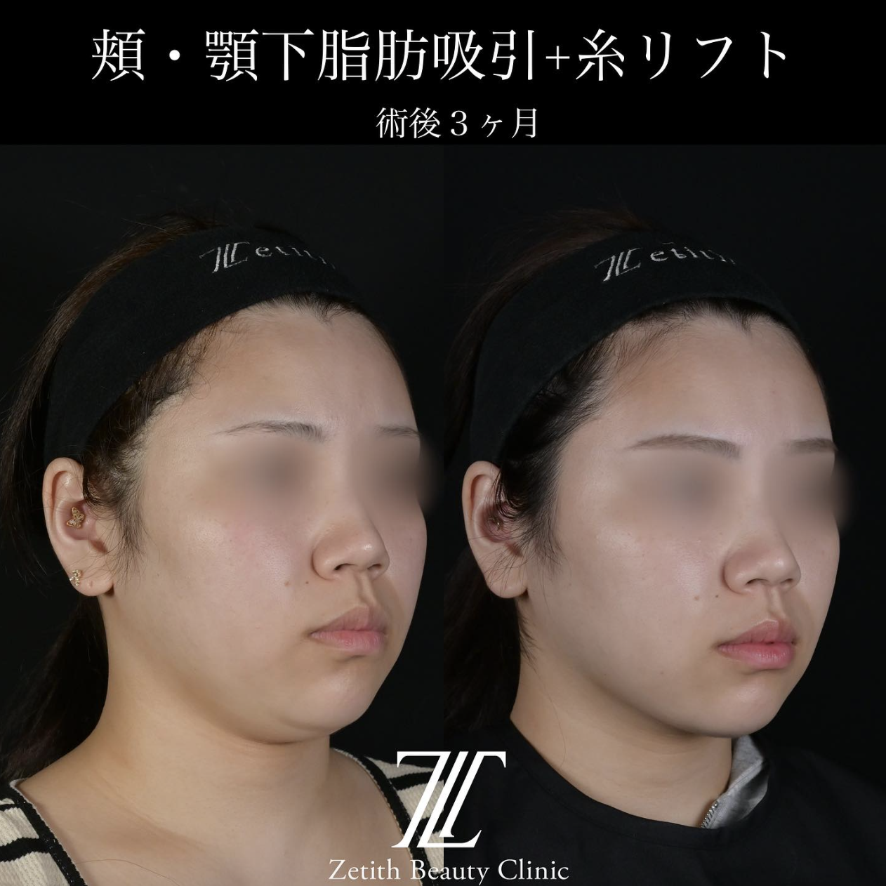 北村医師による脂肪吸引リフトの施術前／施術後3ヶ月 بعد 