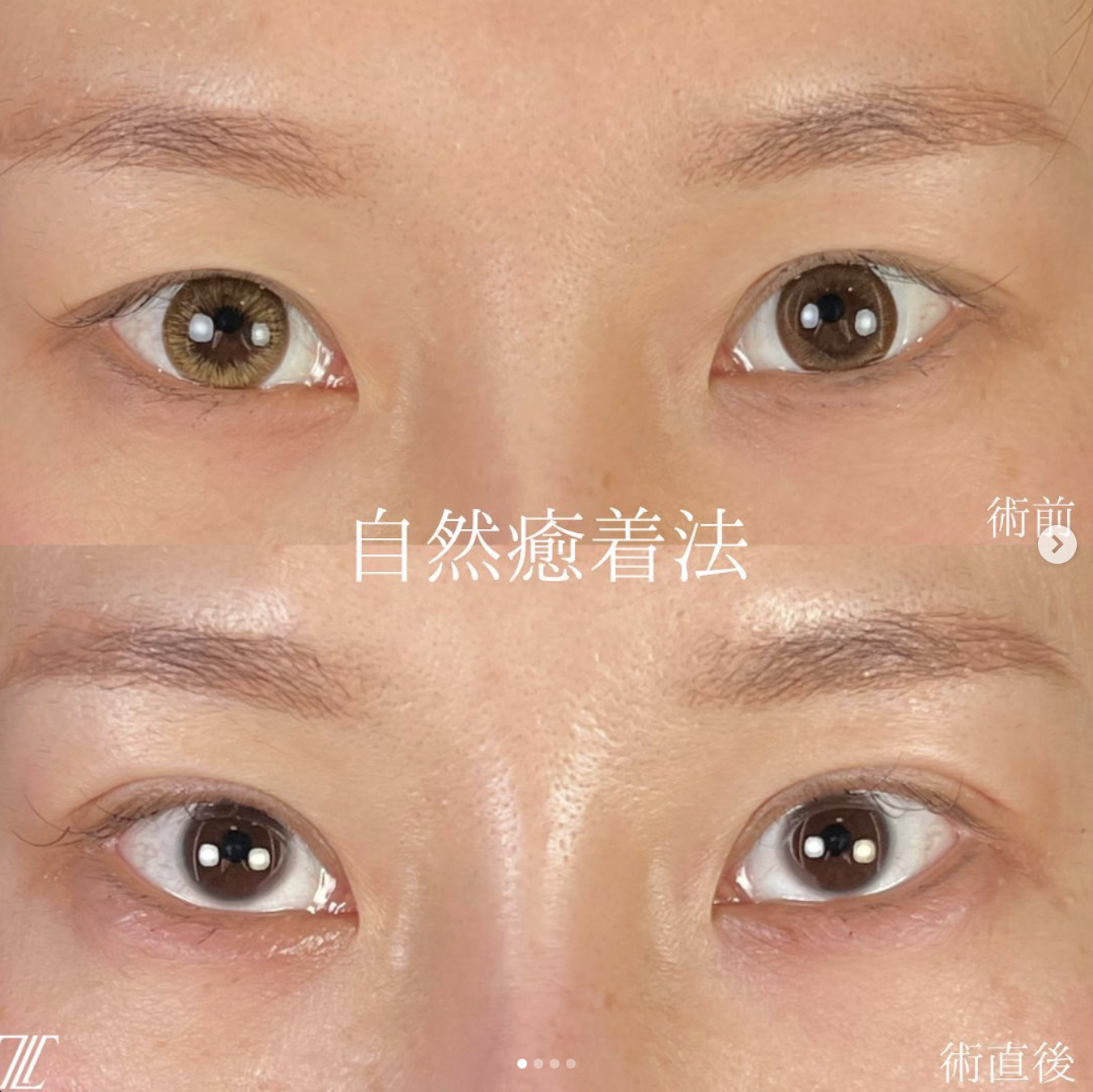 沈医師による二重埋没法の施術前／施術直後