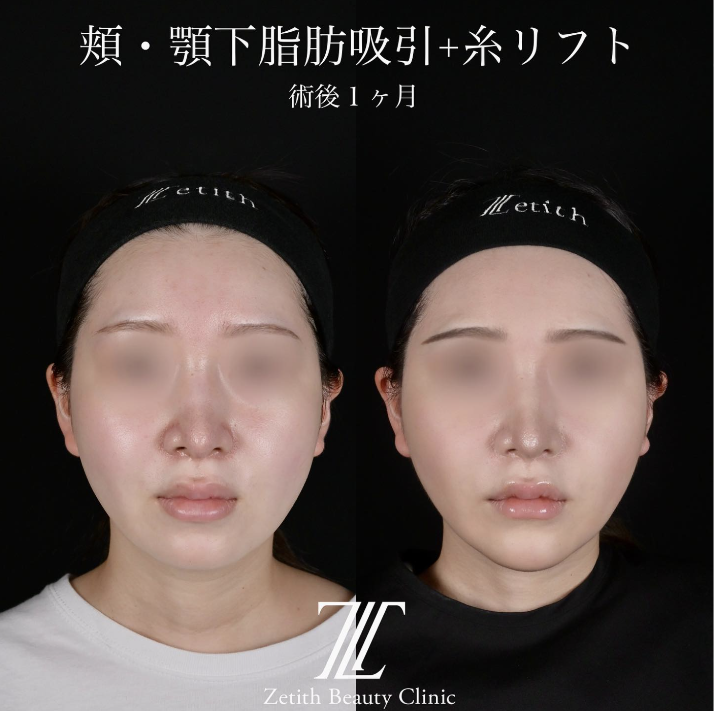 北村医師による脂肪吸引リフトの施術前／施術後1ヶ月