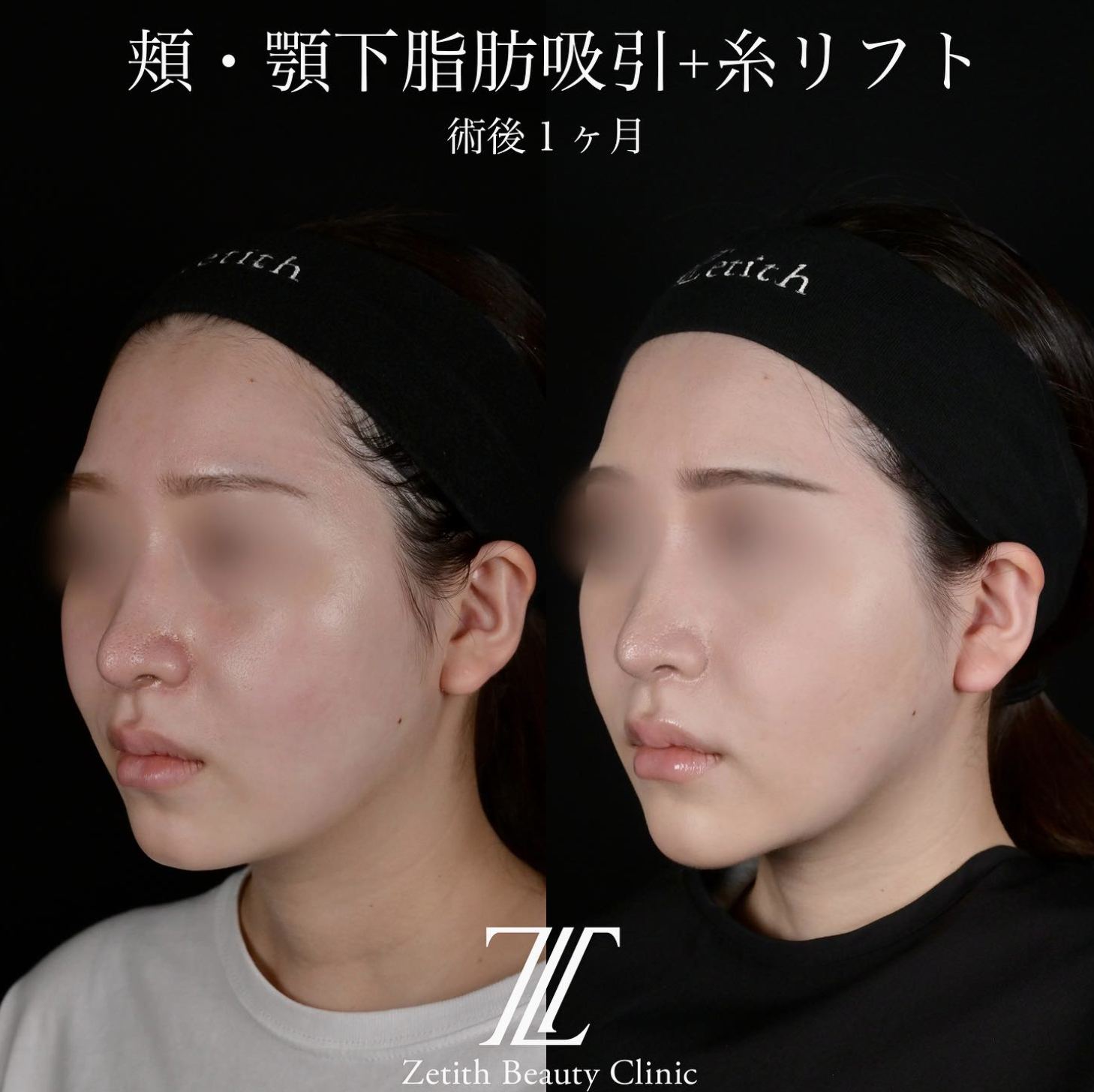 北村医師による脂肪吸引リフトの施術前／施術後1ヶ月 施術後 