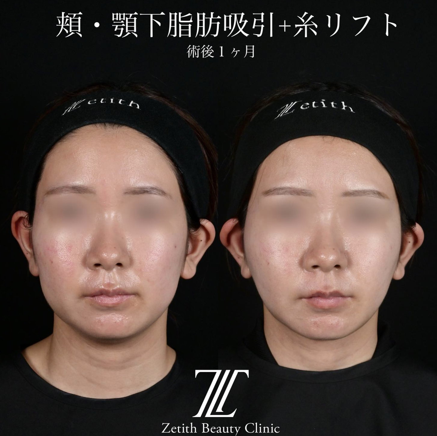 北村医師による脂肪吸引リフトの施術前／施術後1ヶ月