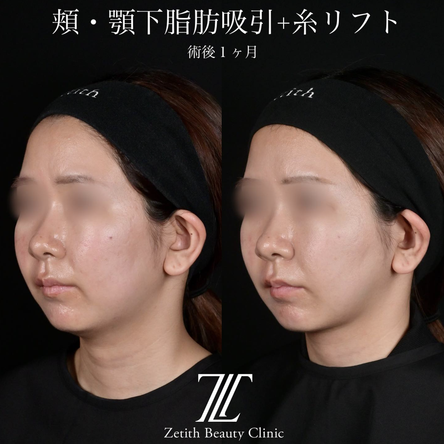 北村医師による脂肪吸引リフトの施術前／施術後1ヶ月 施術後 