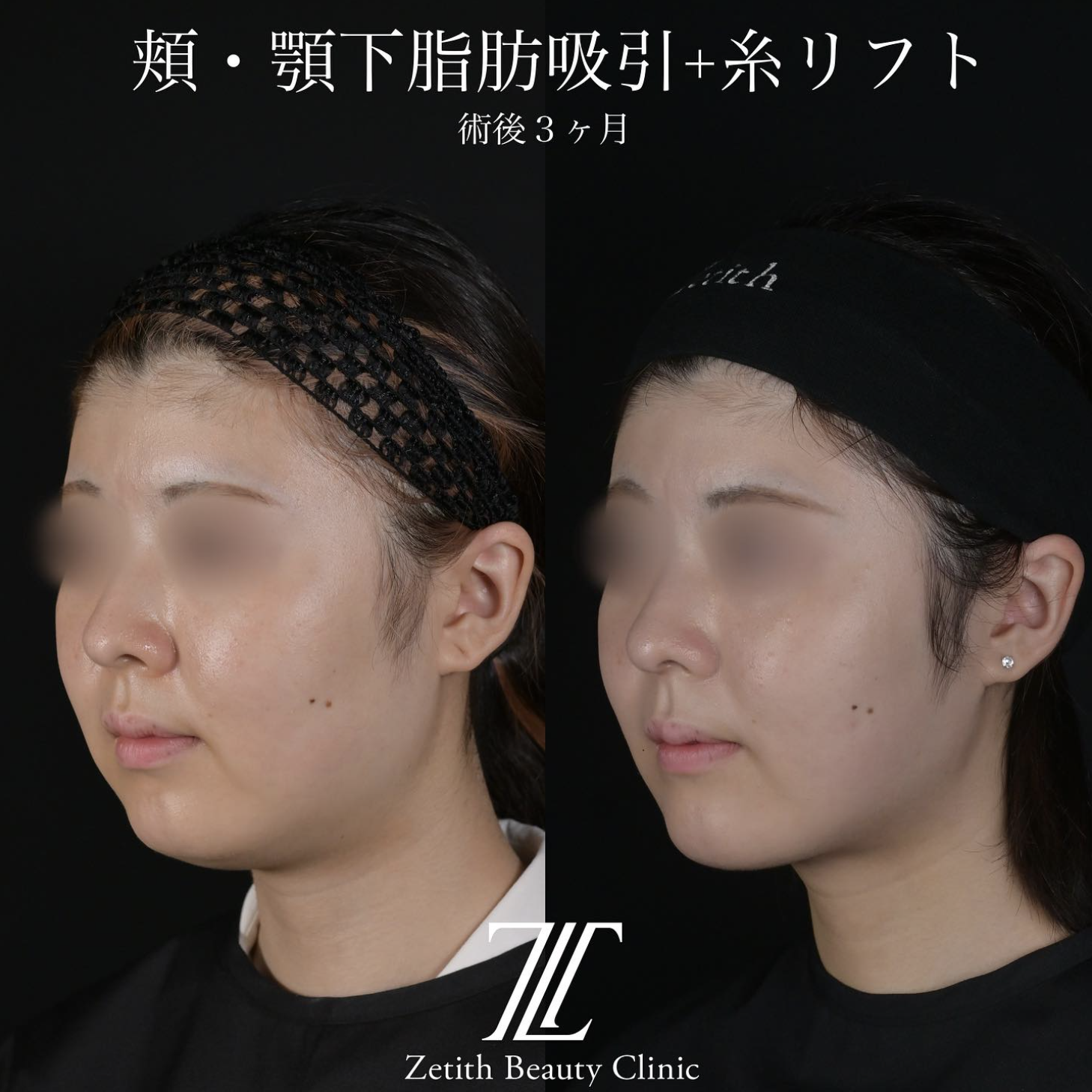 北村医師による脂肪吸引リフトの施術前／施術後3ヶ月後