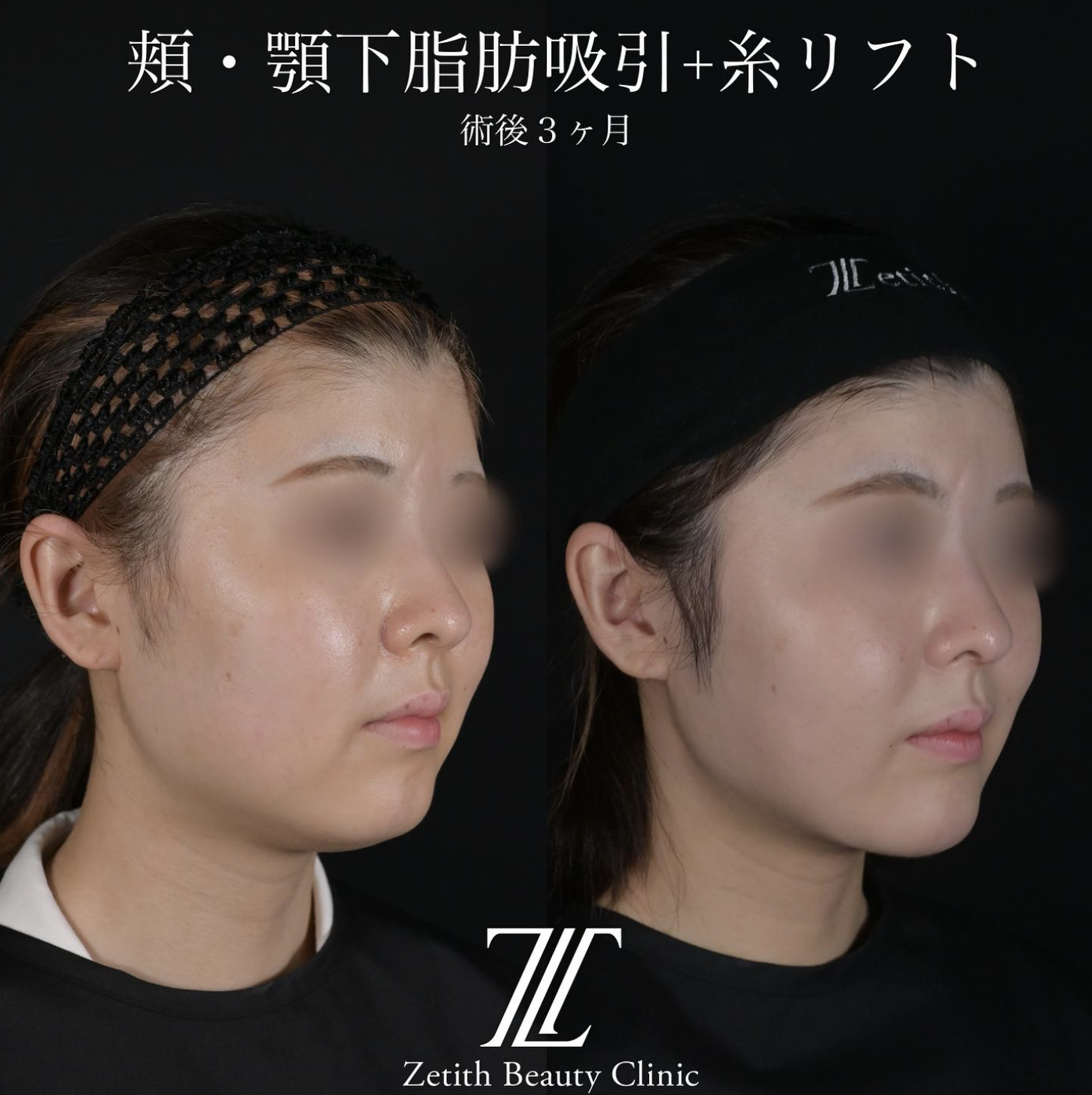 北村医師による脂肪吸引リフトの施術前／施術後3ヶ月後 بعد 