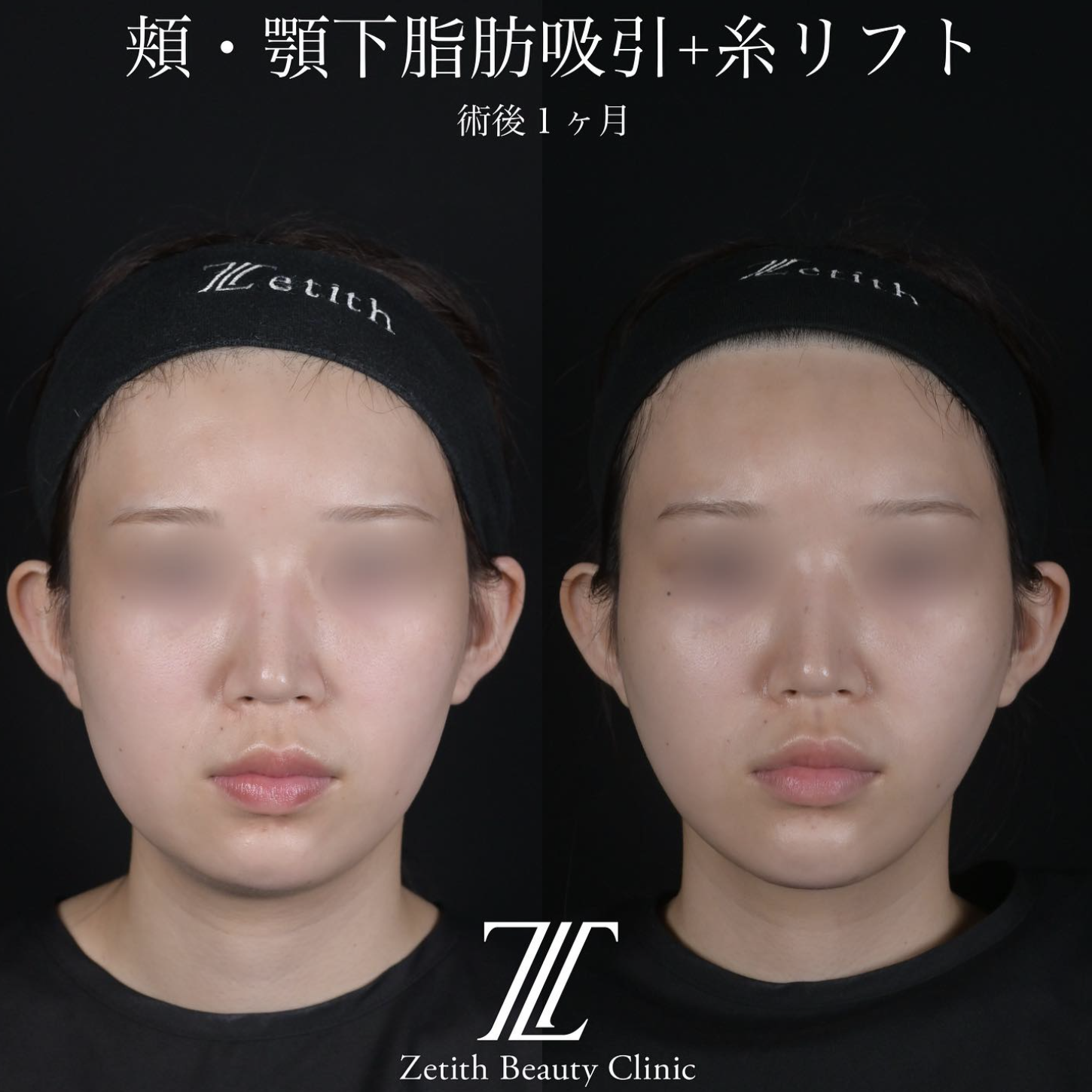 北村医師による脂肪吸引リフトの施術前／施術後1ヶ月