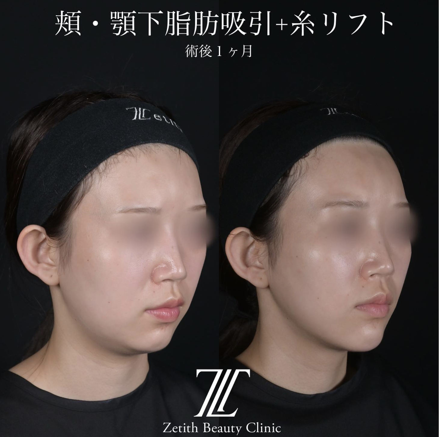 北村医師による脂肪吸引リフトの施術前／施術後1ヶ月 施術後 