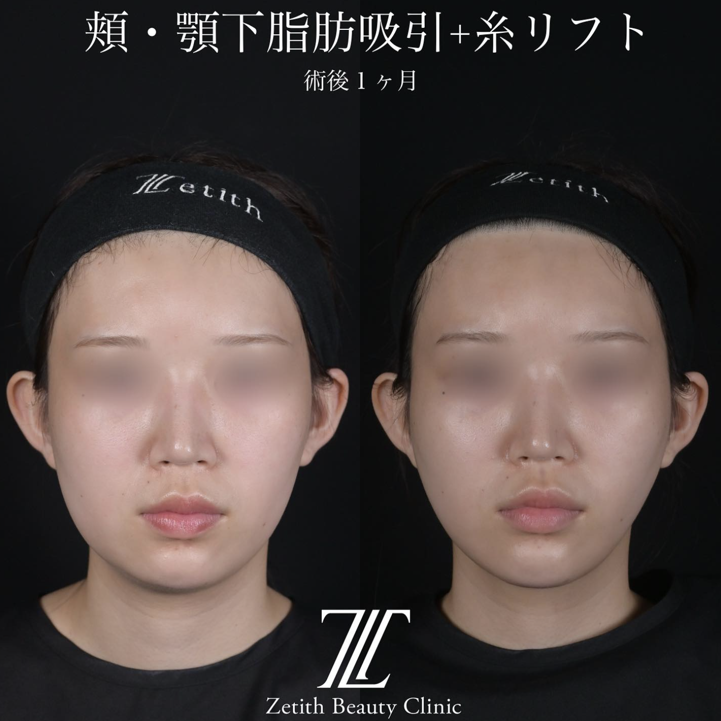北村医師による脂肪吸引リフトの施術前／施術後1ヶ月後