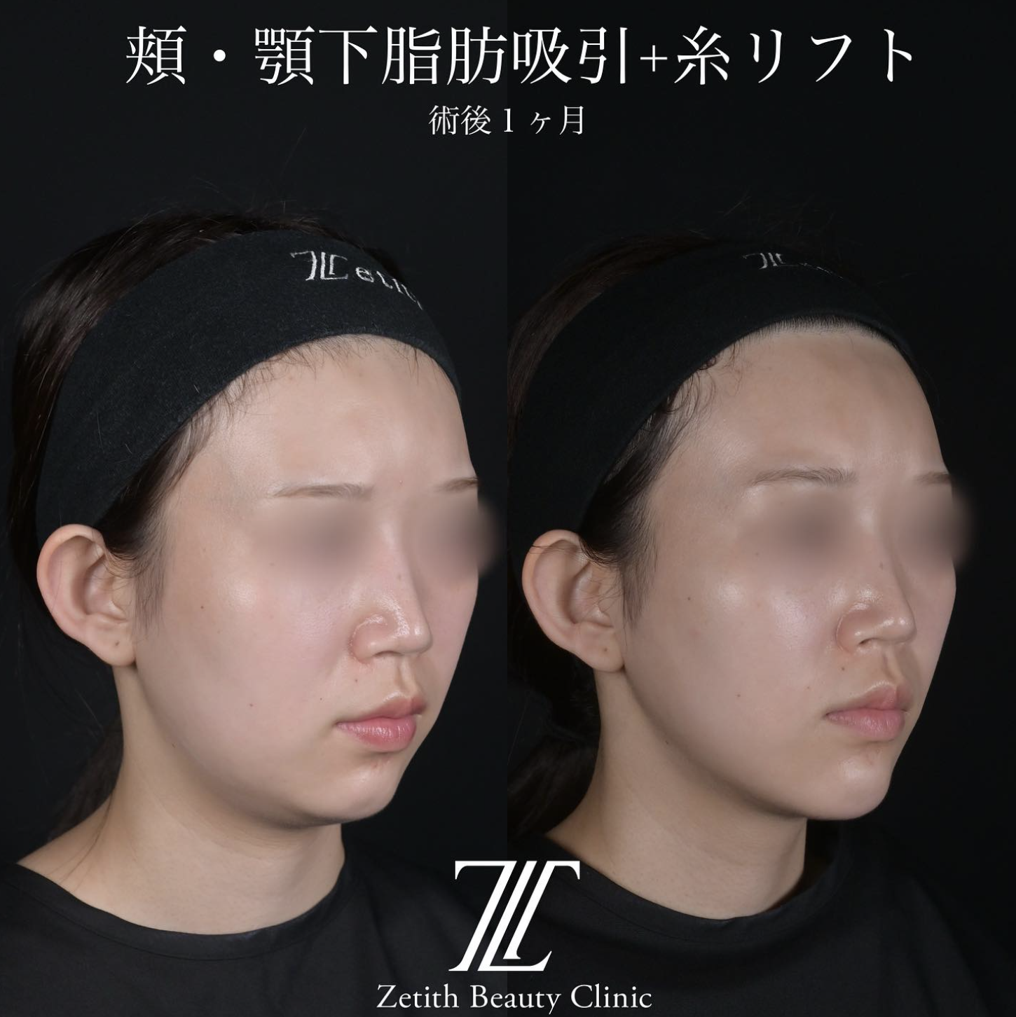 北村医師による脂肪吸引リフトの施術前／施術後1ヶ月後 Дараа 
