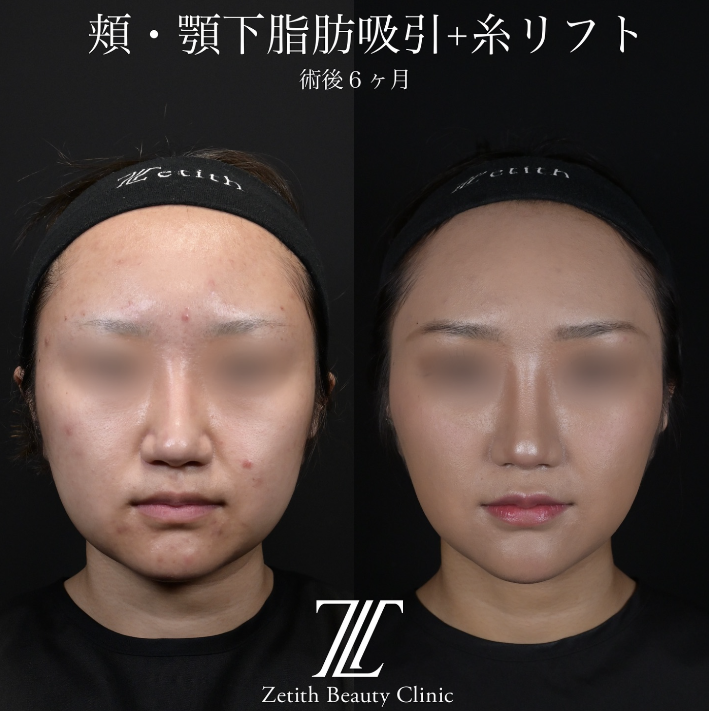 北村医師による脂肪吸引リフトの施術前／施術後6ヶ月