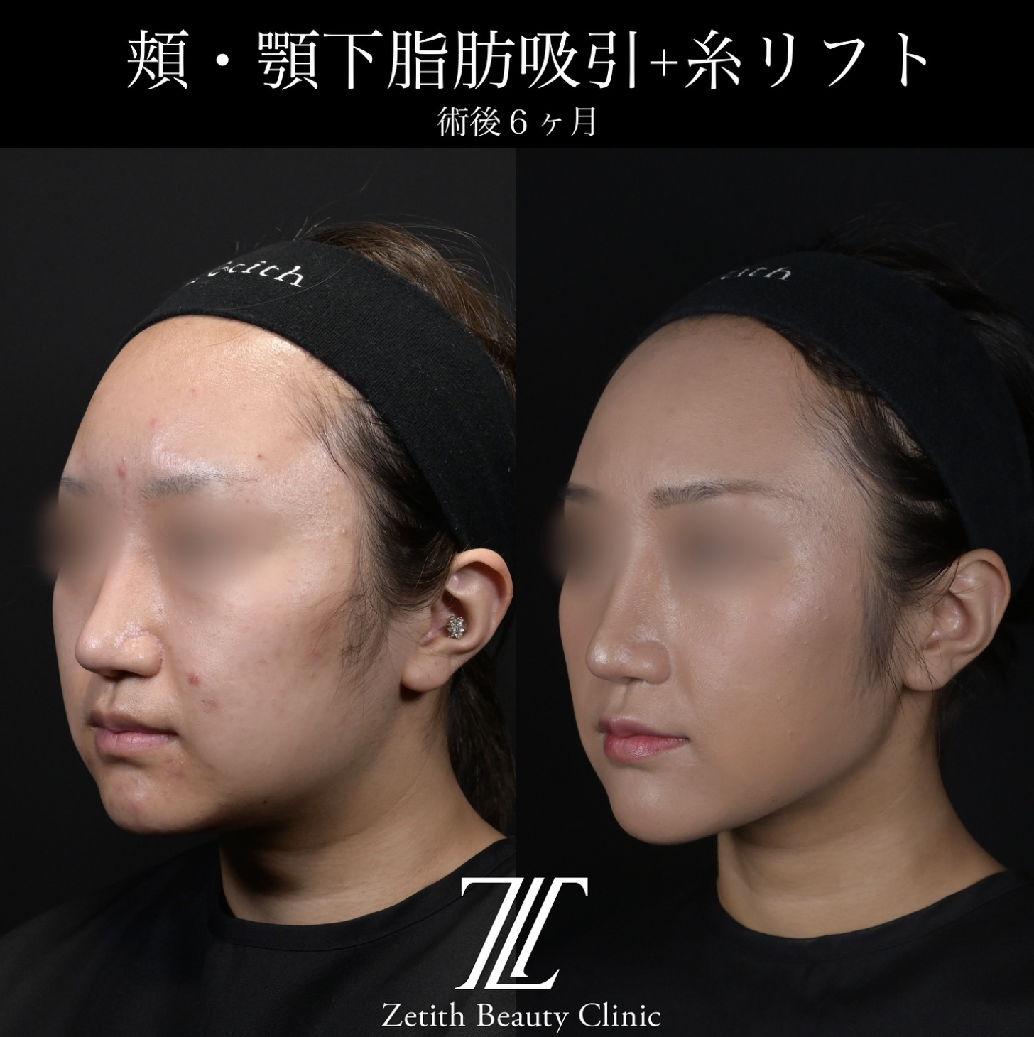 北村医師による脂肪吸引リフトの施術前／施術後6ヶ月 Дараа 