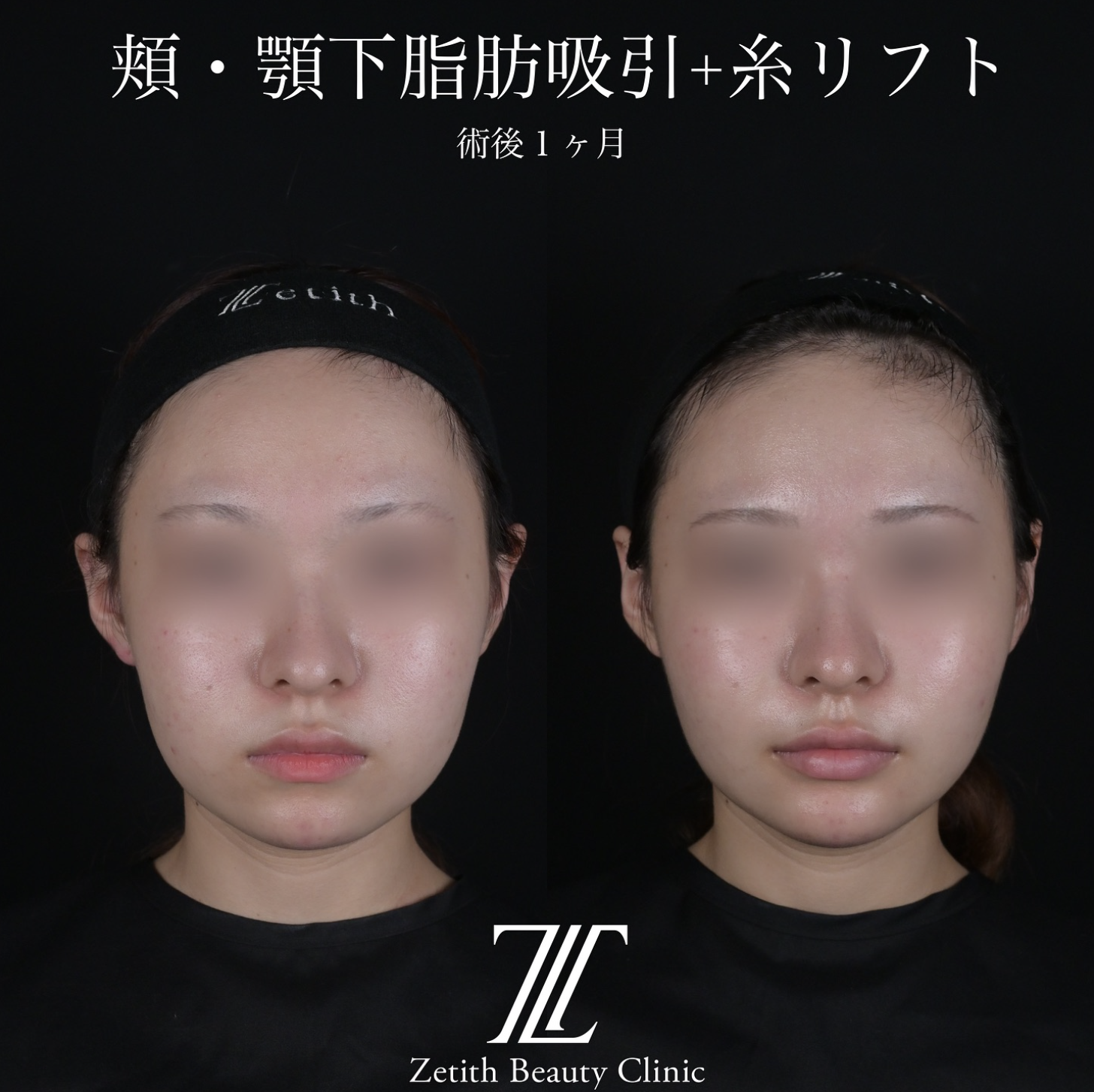 北村医師による脂肪吸引リフトの施術前／施術後1ヶ月